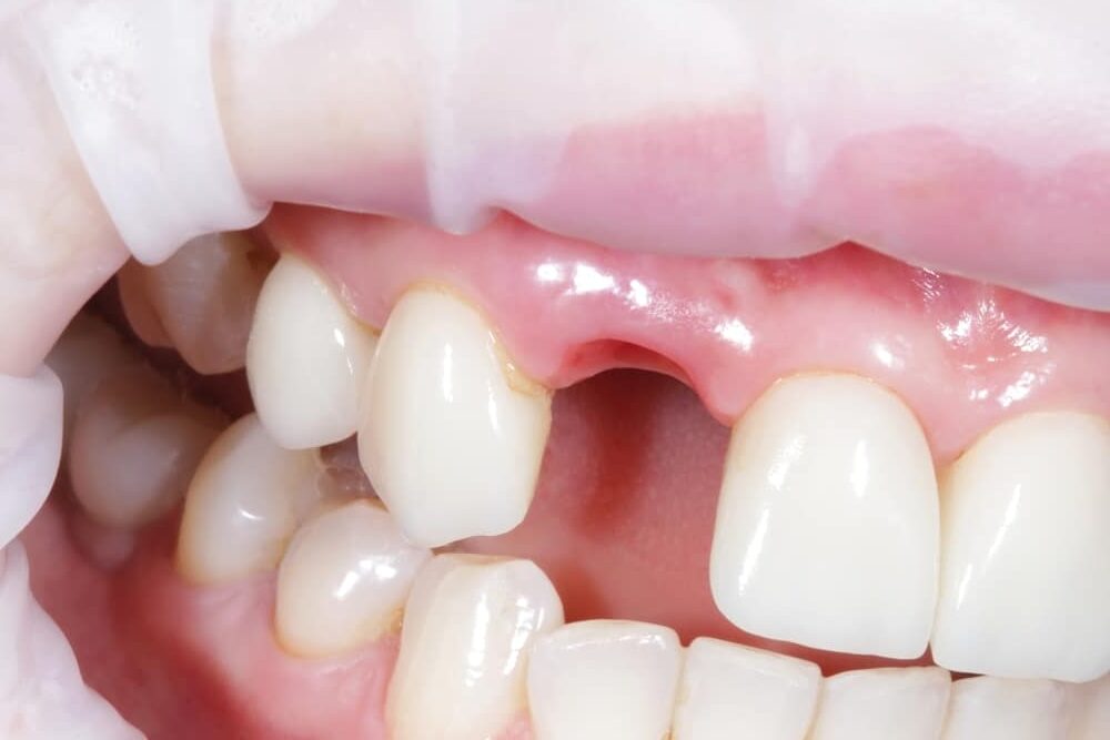 Woman,Showing,Mouth,Without,Broken,Tooth.,Gap,Toothed.,High,Quality 1765403640 379cf3a1eac3494eb3fcc398189b702e 1 e1770404004859