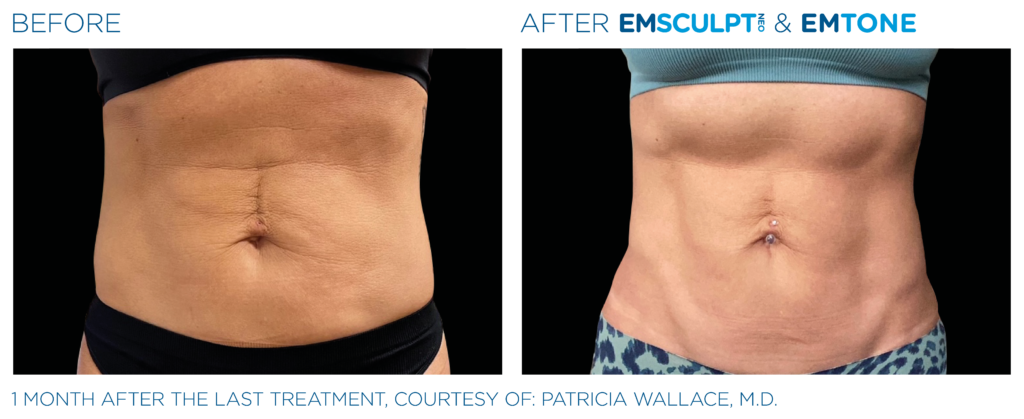 Emsculpt Neo | Melbourne, FL | Gentle Dental