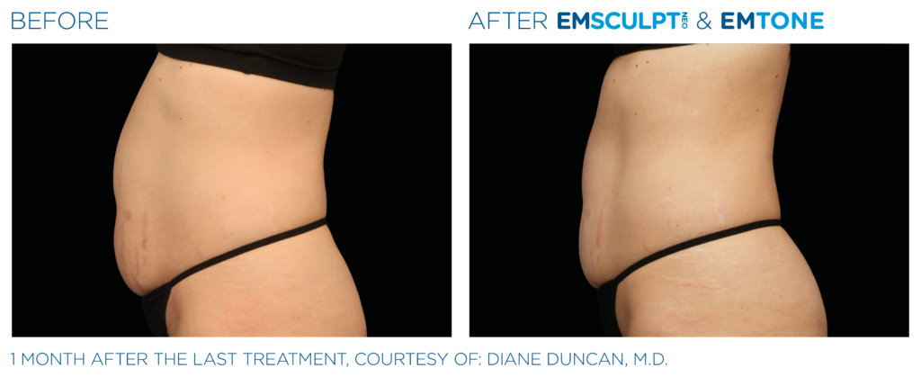 Emsculpt Neo | Melbourne, FL | Gentle Dental