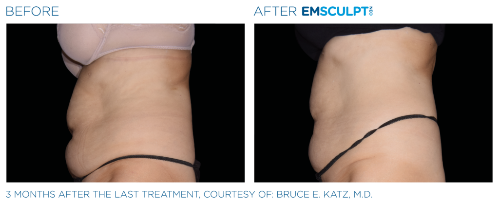 Emsculpt Neo before After | Melbourne, FL | Gentle Dental