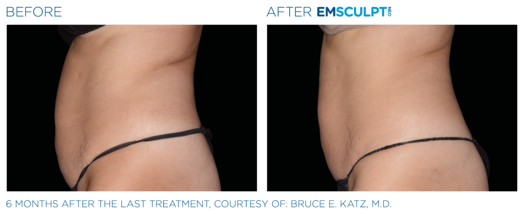 Emsculpt Neo before After | Melbourne, FL | Gentle Dental