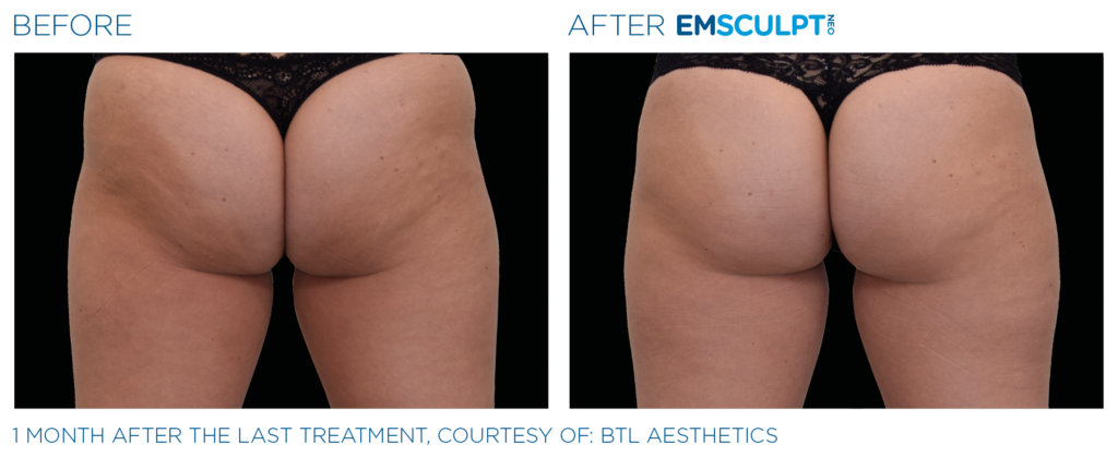 Emsculpt Neo before After | Melbourne, FL | Gentle Dental