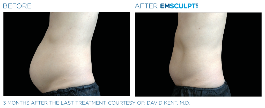 Emsculpt Neo before After | Melbourne, FL | Gentle Dental