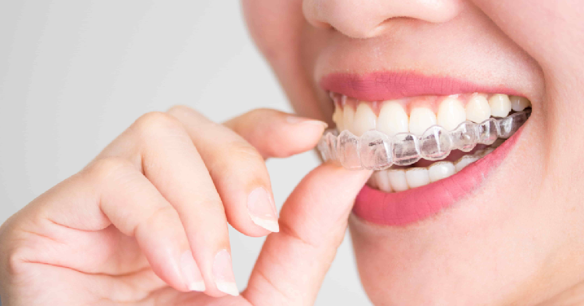 A woman smiles while placing a clear dental aligner on her upper teeth at an Invisalign Specialist in Melbourne, FL.