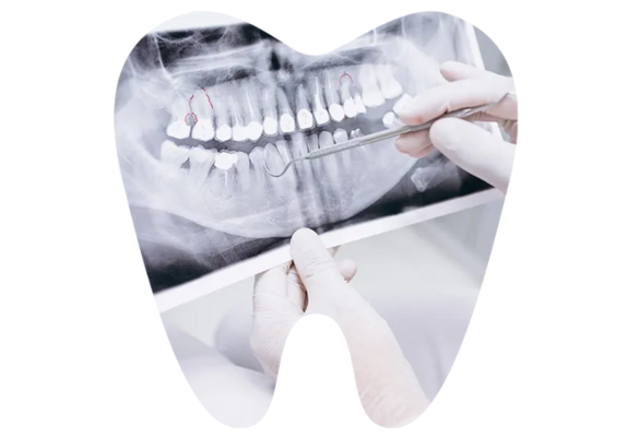 Dental Implants Dental Implants