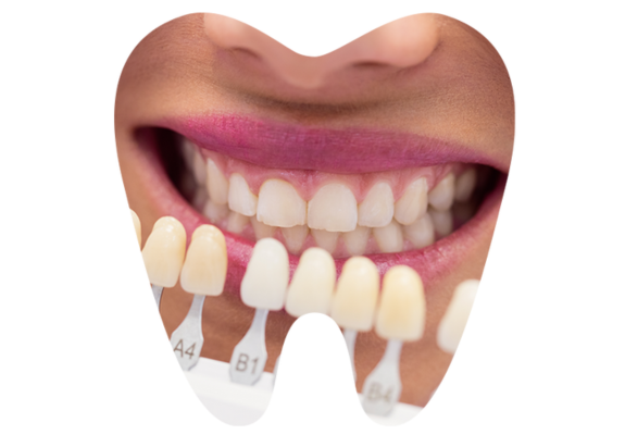 Dental Veneers Dental Veneers